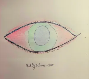 eye flu